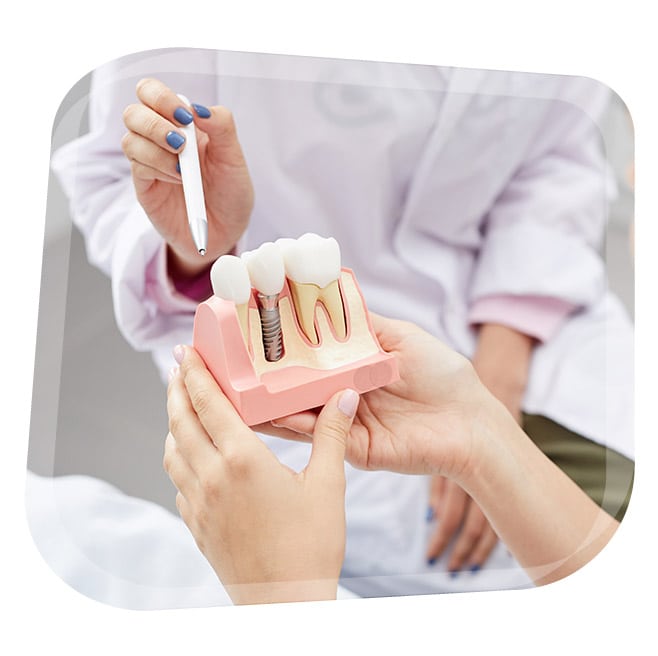 Implantes Dentales en Granada